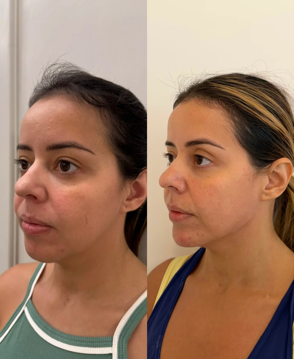 Caso clínico autorizado de planejamento facial realizado pela Dra. Lhuana — Bioestimulador de Colágeno