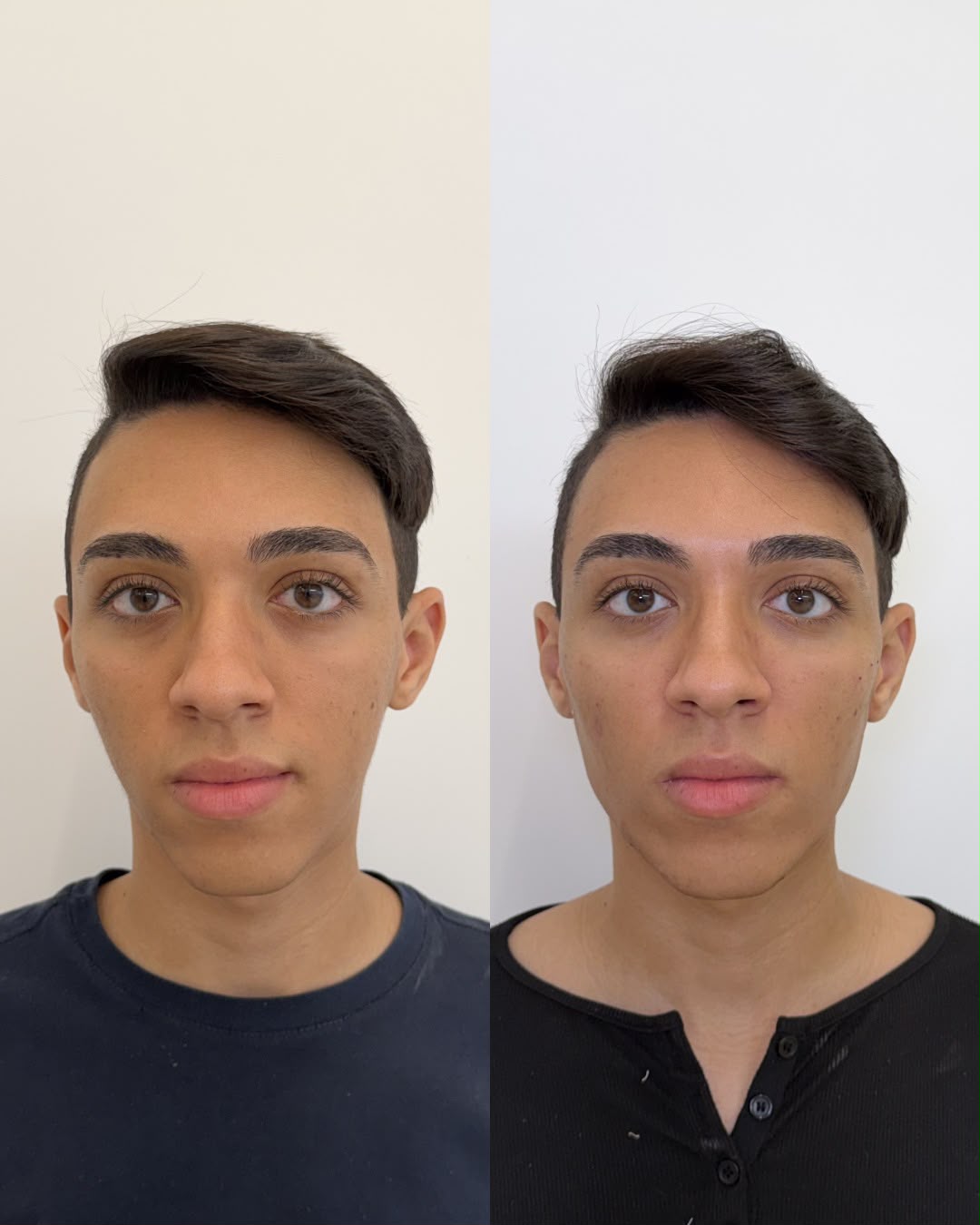Comparação clínica autorizada completa de harmonização facial realizada pela Dra. Lhuana — Harmonização Facial para Homens e Mulheres e Mulheres