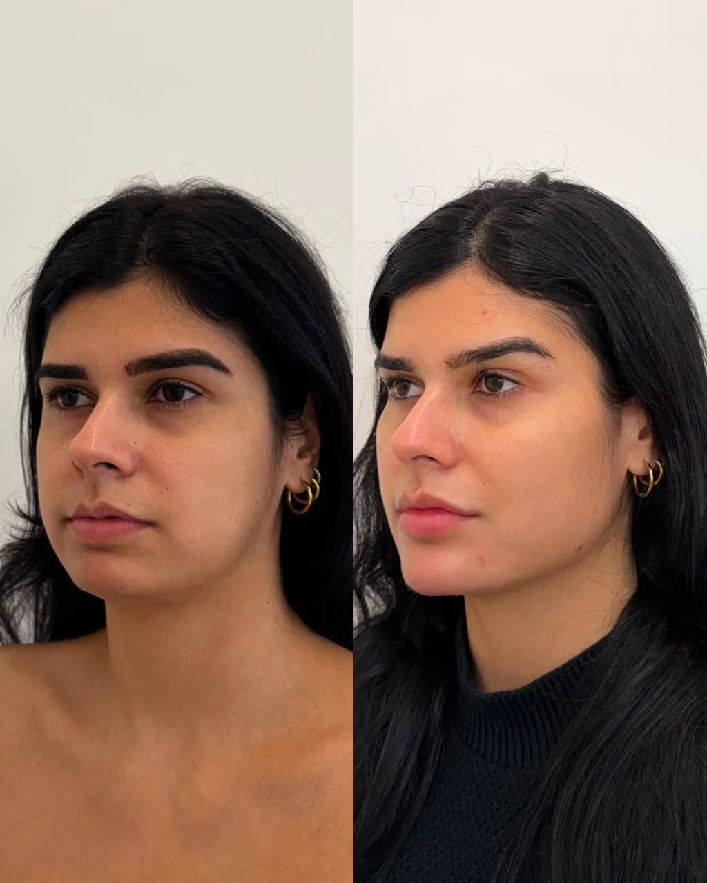 Caso clínico comparativo de planejamento Full Face realizado pela Dra. Lhuana — Harmonização Full Face