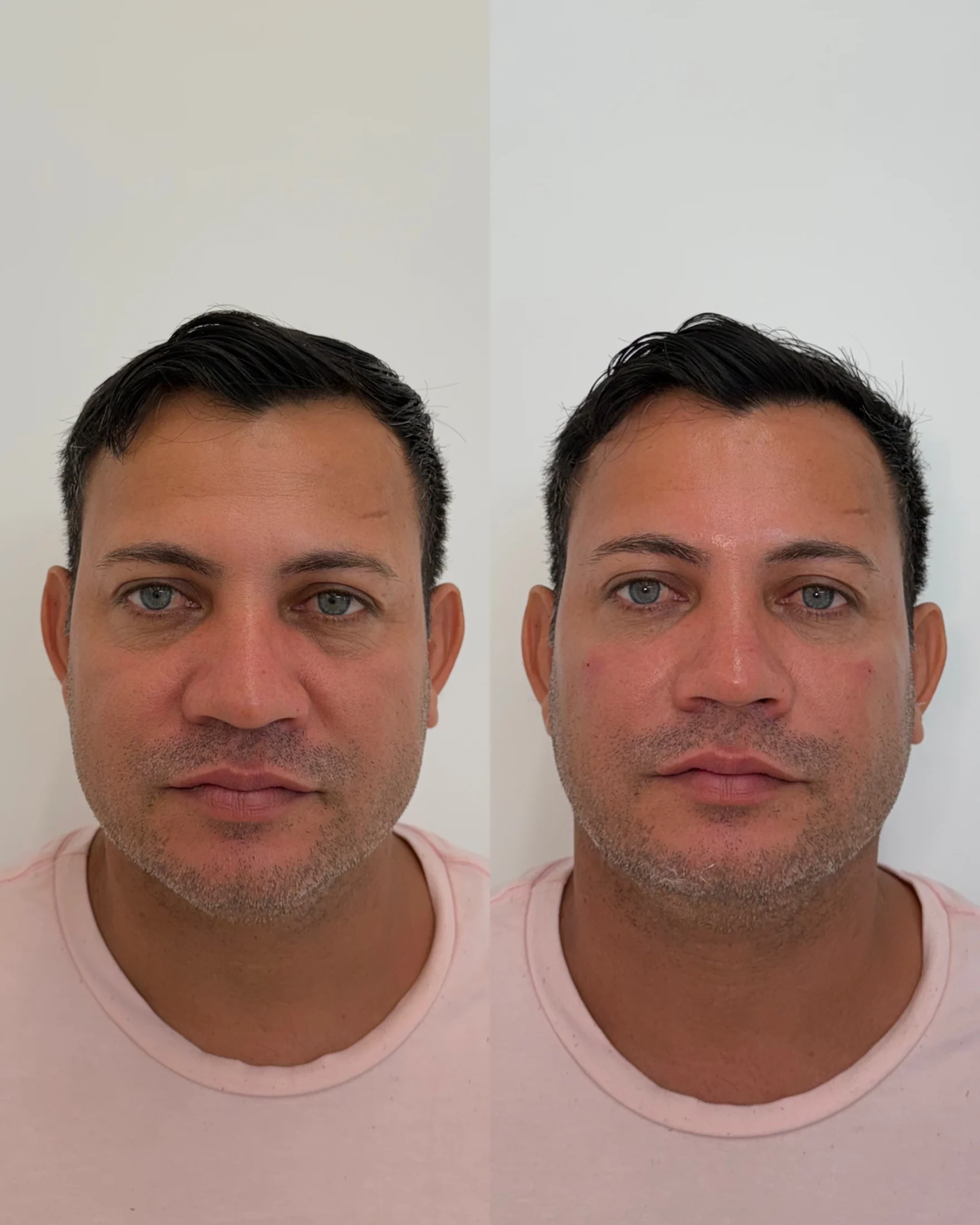 Comparação clínica autorizada frontal para análise de contorno facial