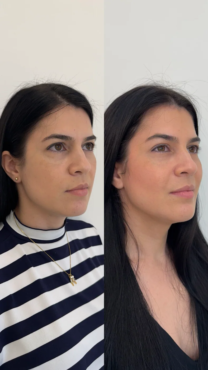 Caso clínico frontal de planejamento facial realizado pela Dra. Lhuana — Preenchimento Facial