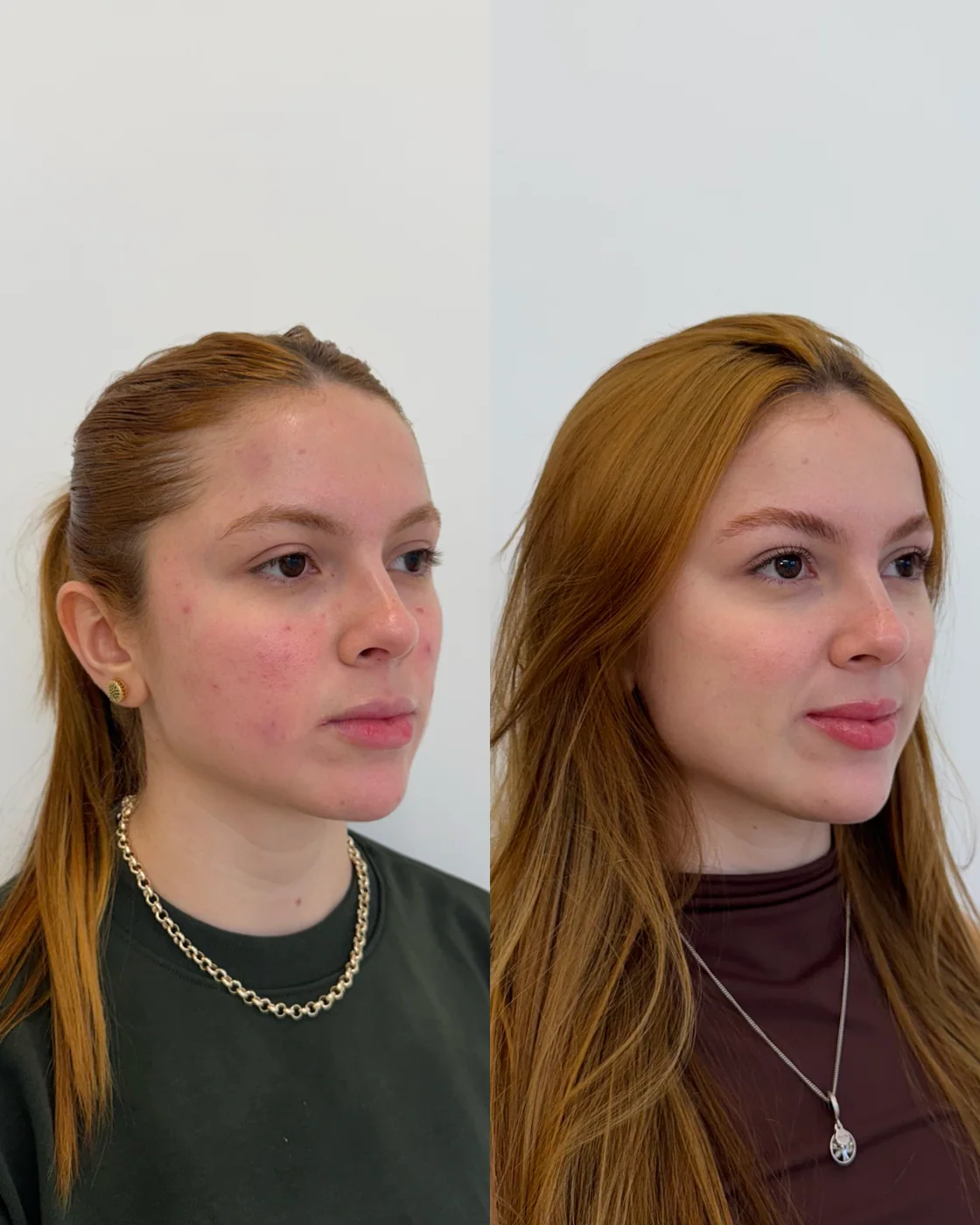 Caso clínico em perfil de planejamento facial realizado pela Dra. Lhuana — Preenchimento Labial